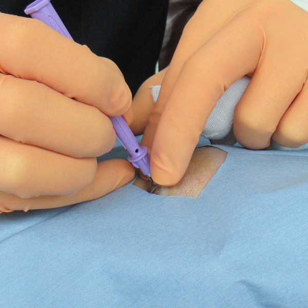 粉瘤(アテローム)