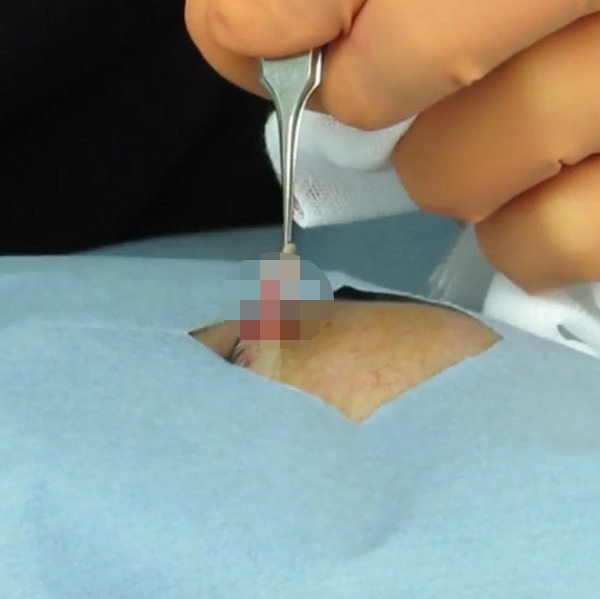 粉瘤(アテローム)