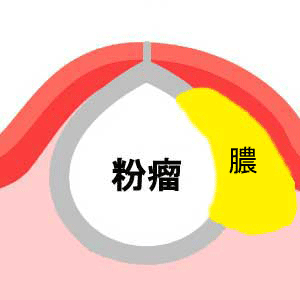 粉瘤(アテローム)