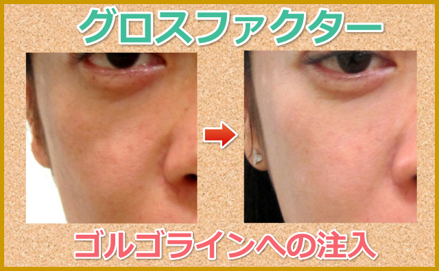 グロスファクター