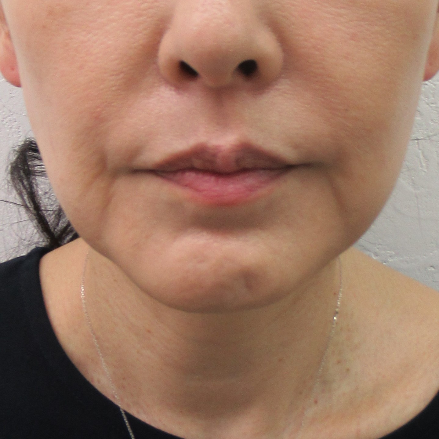 フェイスリフト