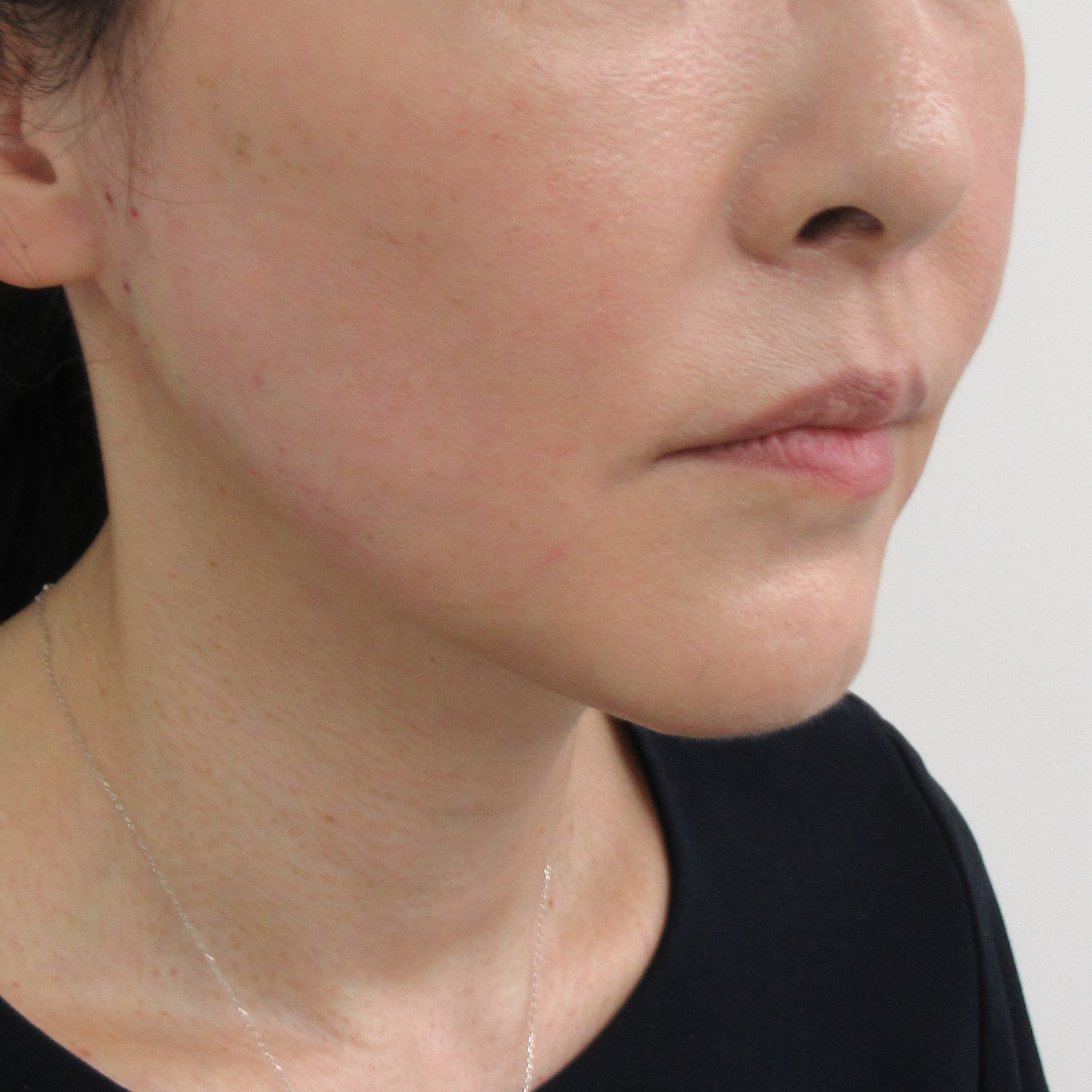 フェイスリフト