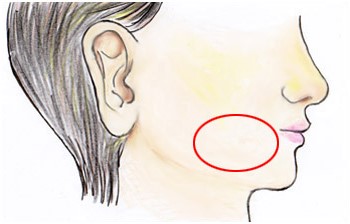 フェイスリフト