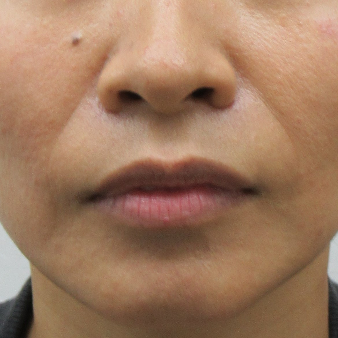 法令線,鼻唇溝,画像