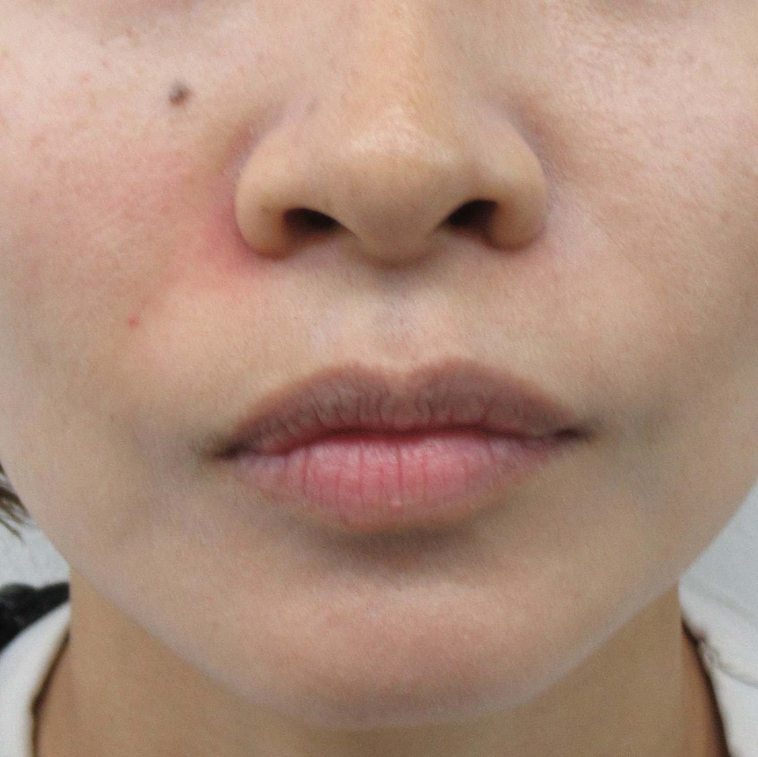 法令線,鼻唇溝,写真