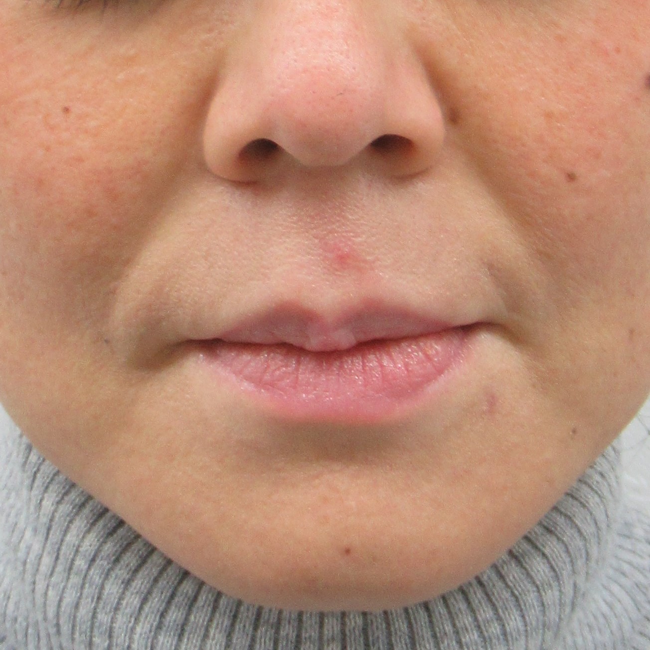 法令線（鼻唇溝）,画像