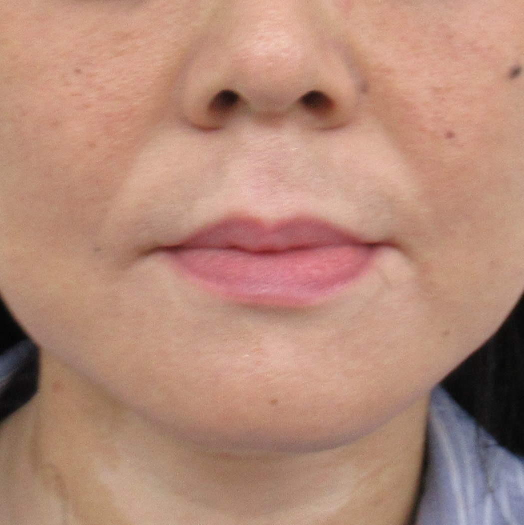 法令線（鼻唇溝）,写真
