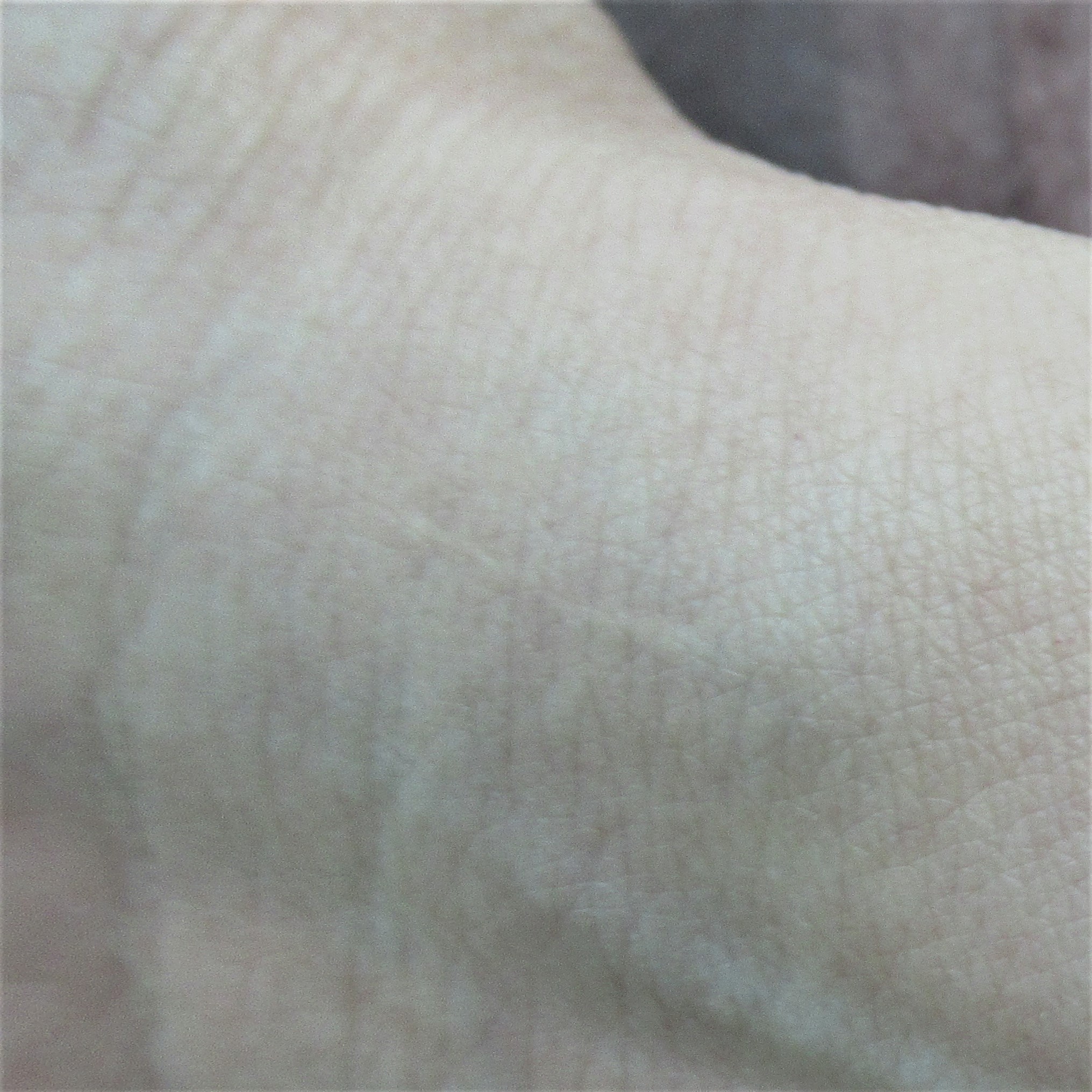 リストカット跡