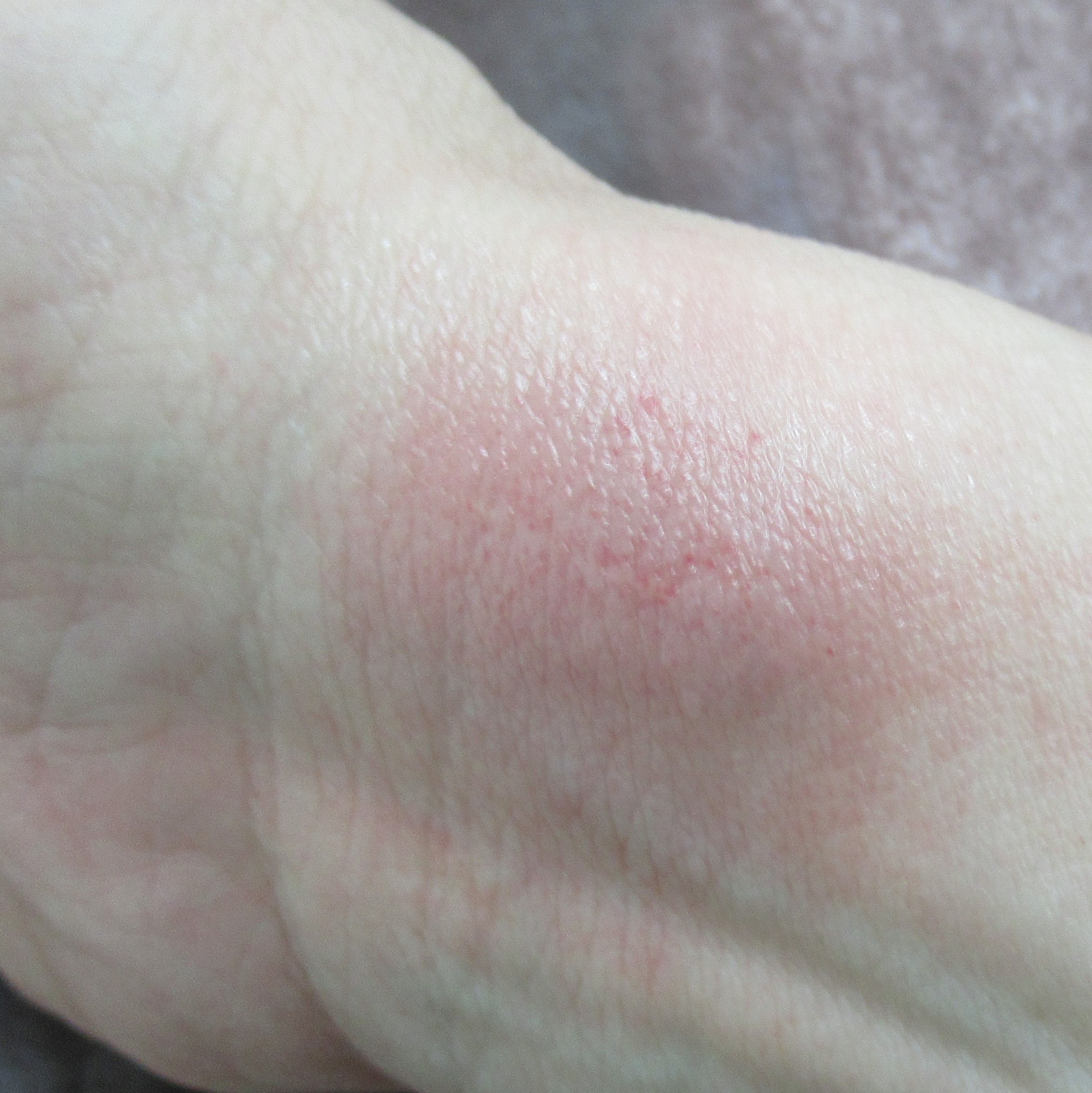 リストカット跡