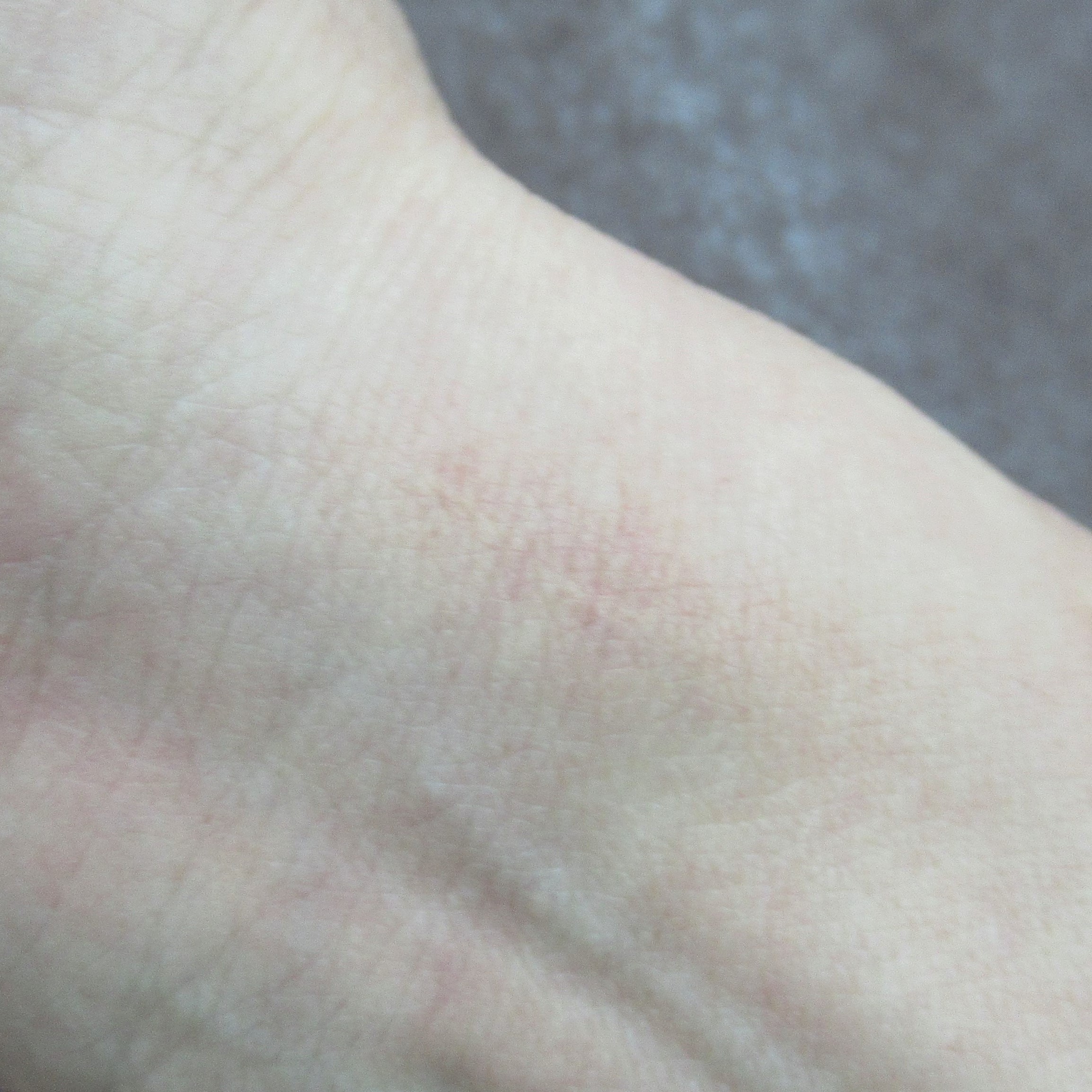 リストカット跡