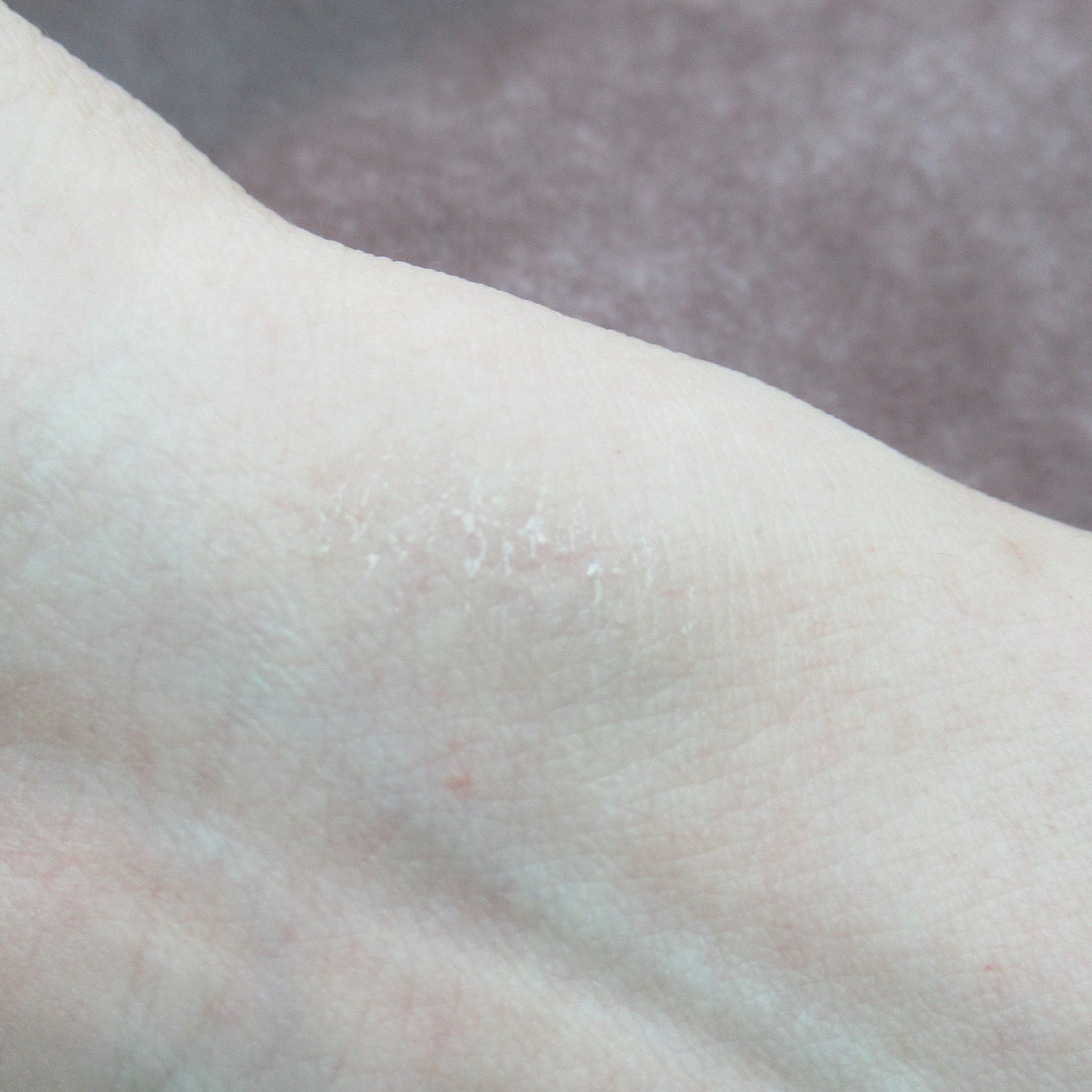 リストカット跡