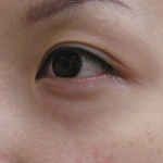 眼の下のくま前:写真