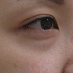 目の下のたるみ前:画像