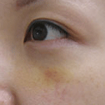 眼元たるみ一週間後;写真
