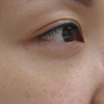 目元たるみ一週間:画像