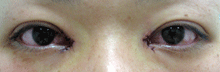 目頭切開,直後,画像