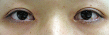 目頭切開,施術前,写真