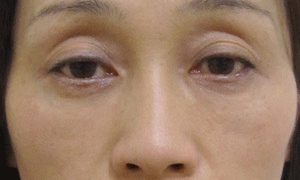 目の下 ふくらみ