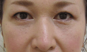 目の下 ふくらみ