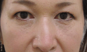 目の下 ふくらみ