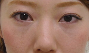 目の下 ふくらみ