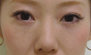 目の下 ふくらみ