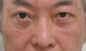 目の下 ふくらみ