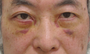 目の下 ふくらみ