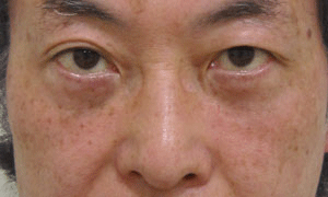 目の下 ふくらみ