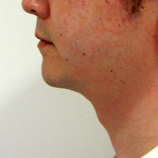 プチ脂肪吸引,写真