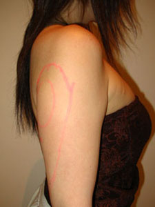 プチ脂肪吸引,画像