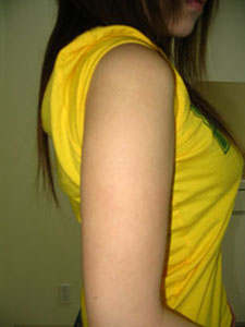 プチ脂肪吸引,写真