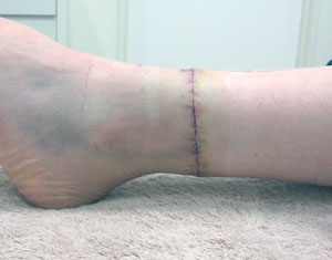 TATTOO,刺青切除法