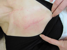 TATTOO,刺青切除法,写真