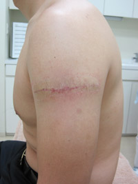 TATTOO,刺青切除法,写真