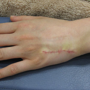 TATTOO,刺青切除法,写真