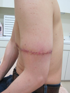 TATTOO,刺青切除法,写真