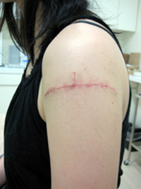 TATTOO,刺青切除法,写真