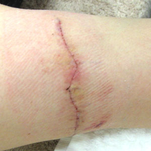 TATTOO,刺青切除法